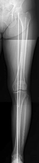 88 신영수 이대희 이순혁외 2 인 Figure 2. Bilateral weight bearing anteroposterior whole lower limb X-ray in full extension for planning an open wedge high tibial osteotomy.