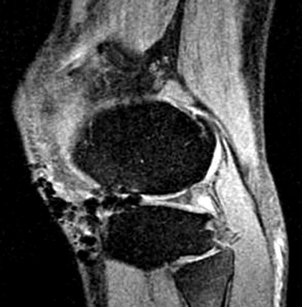 215 대퇴 과 관절 연골 결손의 자가 연골 세포 이식술 Fig. 5.