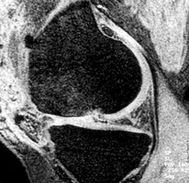 cartilage (C-1) and successful repair at final follow- up (C-2).