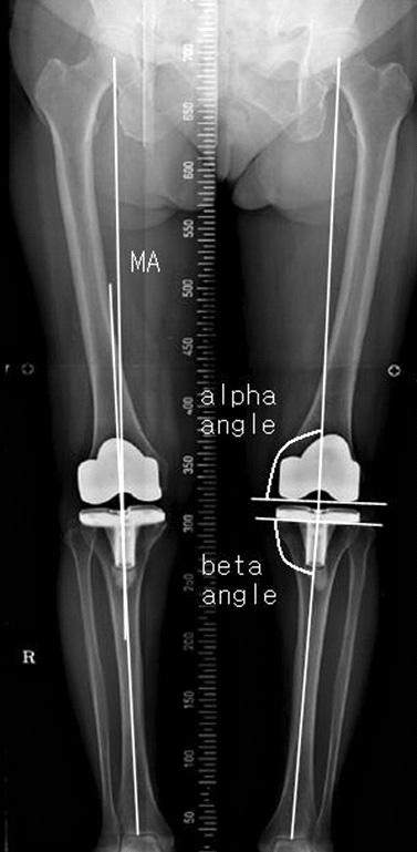inclination angle of the tibial component with the mechanical axis of the tibia (β angle).