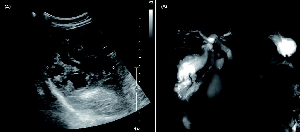 35 Fig. 1. (A) Abdominal ultrasonography shows 8.3x7.6 cm sized multiseptated abscess in right posterior segment of liver. (S6).