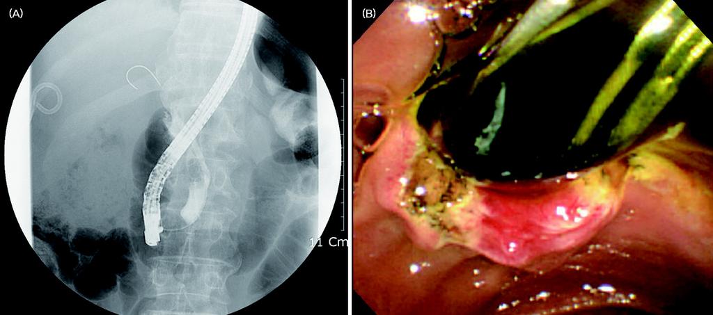 (A) ERCP shows filling defect in common bile duct, contrast media does not fill the common hepatic duct due to mucin.