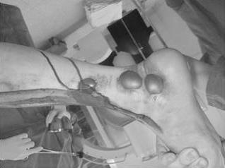 골절의외고정을위해골절상부의경골간부내측및거골과종골내측에나사못을삽입하고외고정기기 (Orthofix, Verona, Italy)