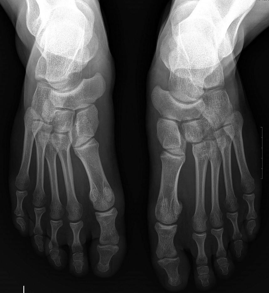 184 Vol. 19 o. 4, December 2015 A B C D Figure 1. Broken screw case. (A) Preoperative anteroposterior (AP) weight-bearing radiograph is shown for a patient with fracture dislocation of Lisfranc joint.