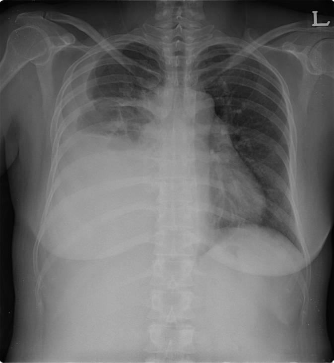 - The Korean Journal of Medicine: Vol. 77, No. 6, 2009 - 증 례 Figure 1. The simple chest X-ray shows a pleural effusion in the right chest. 수있어서잘사용하지않는다 8).