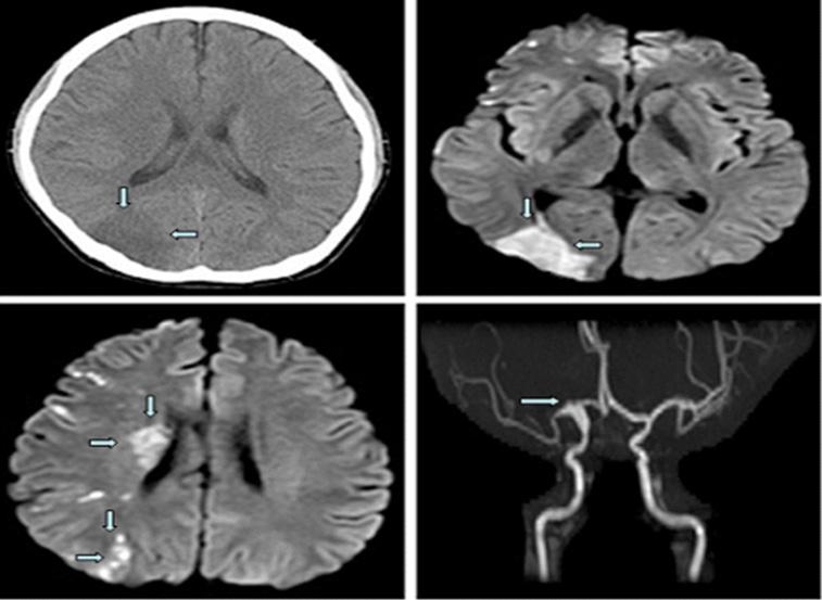 - 대한내과학회지 : 제 77 권제 4 호통권제 590 호 2009 - A B C Figure 2. (A) The initial brain computed tomography reveals a parenchymal low-density area in the right occipital lobe.