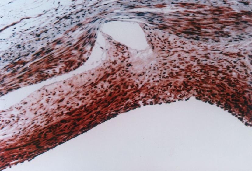 n intense immunostaining with type I collagen in neointima and adventitia of a stented porcine coronary artery at 28 days after stenting (). Magnification 200. Fig.