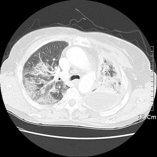 선암 ( 병기 IV) 으로진단되었다. Paclitaxel과 carboplatin 병합항암치료 1주기시행후신경독성이심하여치료약제를 gemcitabine 과 vinorelbine으로바꾸어 3주기를더시행하였다. 병변은치료전과큰차이를보이지않은상태로외래에서추적관찰하던중흉추의골전이가악화되는소견을보여 gefitinib을사용하였다.