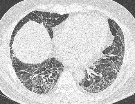 - The Korean Journal of Medicine: Vol. 84, No. 4, 2013 - 가임상의들에게알려진지는오래되었지만그동안이들질환의정확한정의, 분류, 용어등에있어서는학자들간에부분적으로이견이있어왔다 [3,4].