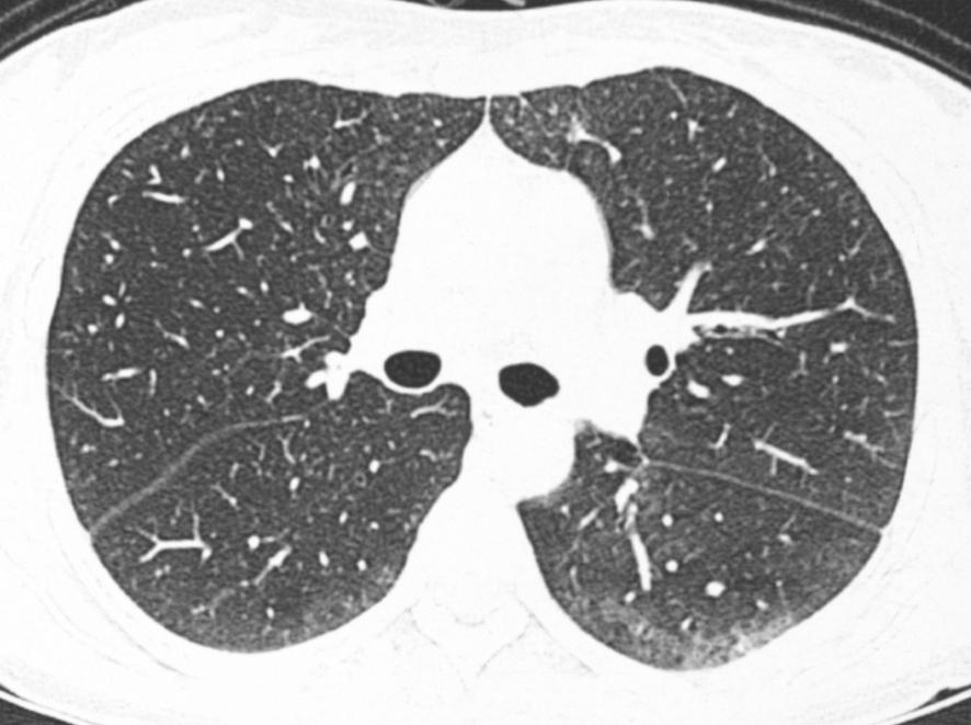 - Yu-Whan Oh. Radiologic approach to the idiopathic interstitial pneumonias - 림프구간질성폐렴림프구간질성폐렴 (lymphocytic interstitial pneumonia, LIP) 은조직학적으로림프구, 형질세포, 조직구등이폐간질에광범위한침윤을특징으로하는드문질환이다 [37].