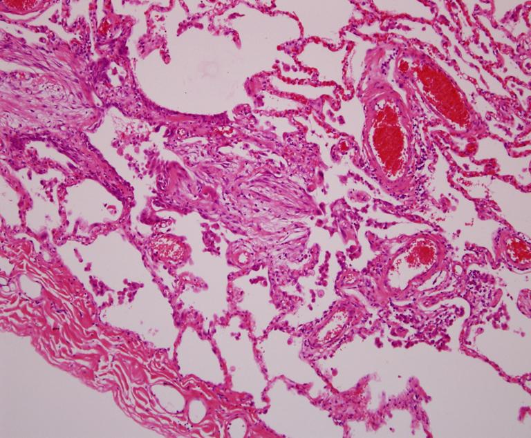 JY Kang et al: Idiopathic bronchiolocentric interstitial pneumonia Figure 2.