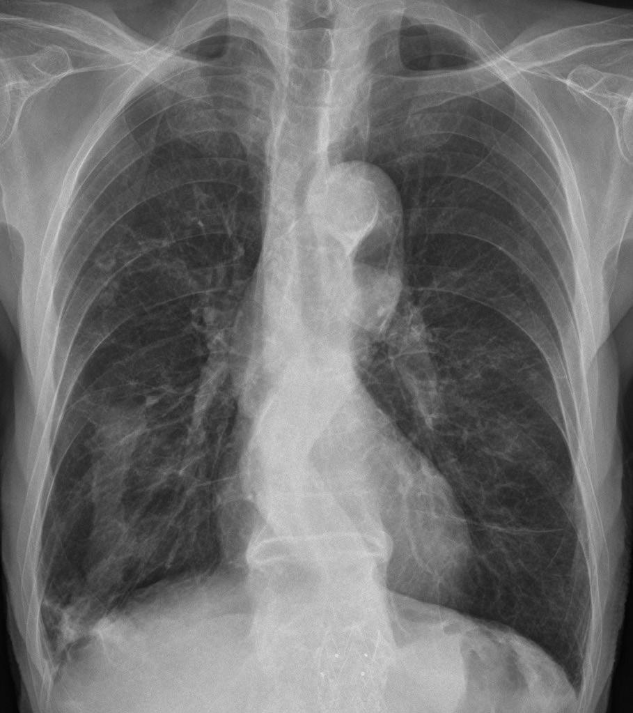 This was confirmed as chronic nonspecific pneumonitis by percutaneous transthoracic needle biopsy. Also note emphysema in both lungs.