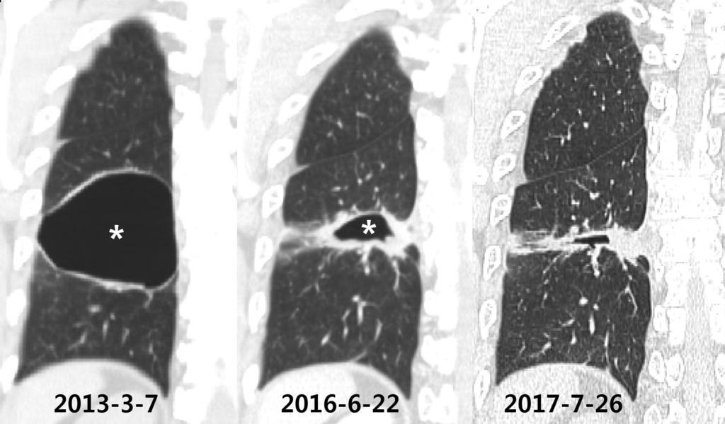 Coronal CT image shows interlobular septal thickening in the right lung (arrows), suggesting pulmonary edema; also note cardiomegaly.