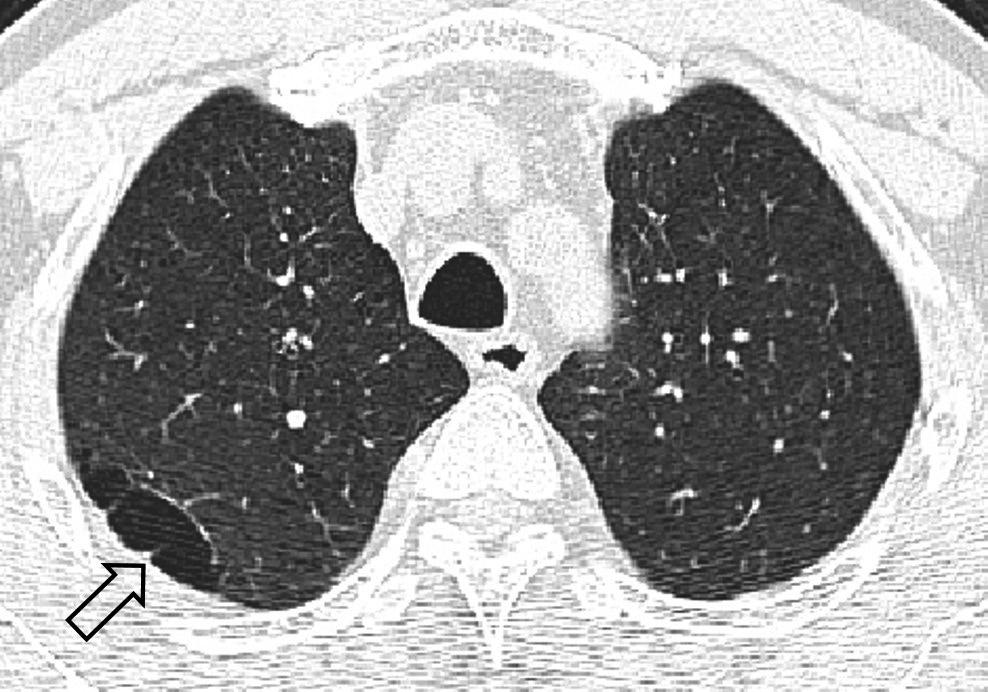 박혜림외 A B Fig. 16. Spontaneous pulmonary hematoma and hemorrhage in a 54-year-old man.