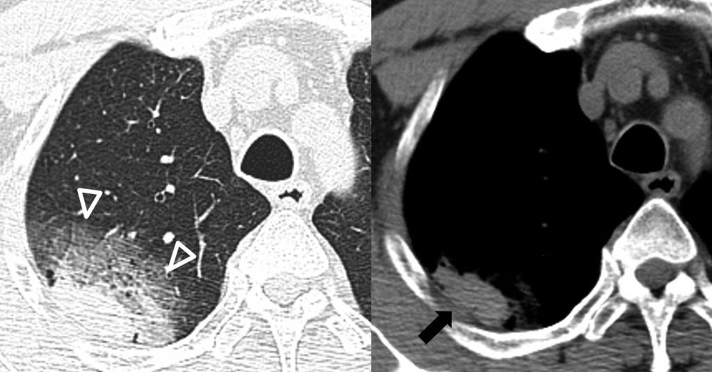 Follow-up CT images show a high-attenuation hematoma (arrow) in the bullae.