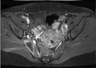 increase in signal intensity on T2-weighted image (arrow).