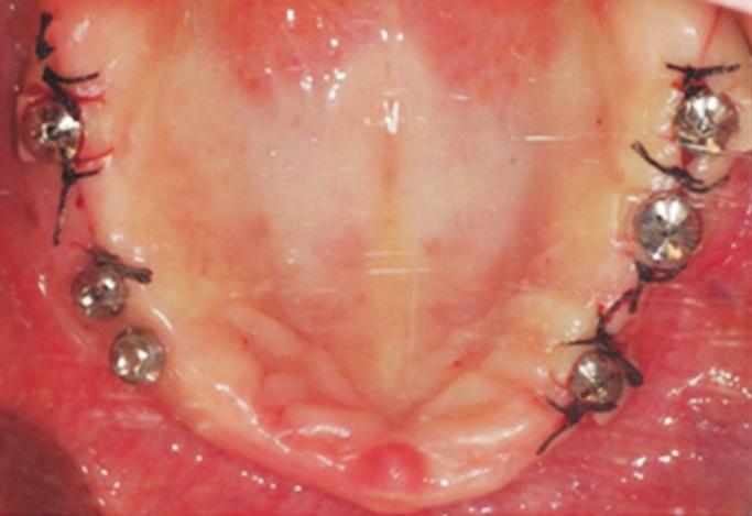 acceptable existing prosthesis or an ideal wax trial denture)