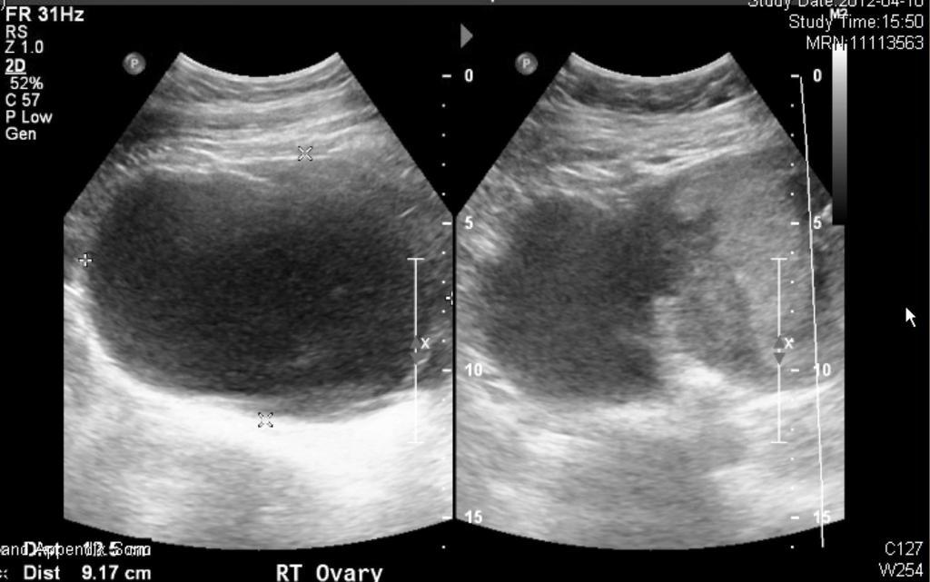 Seoyeon Park, et al. Tuboovarian abscess in pregnancy Fig. 1. Transabdominal sonography. A 12.5 cm-sized right ovarian cyst. Fig. 2. Magnetic resonance imaging findings.