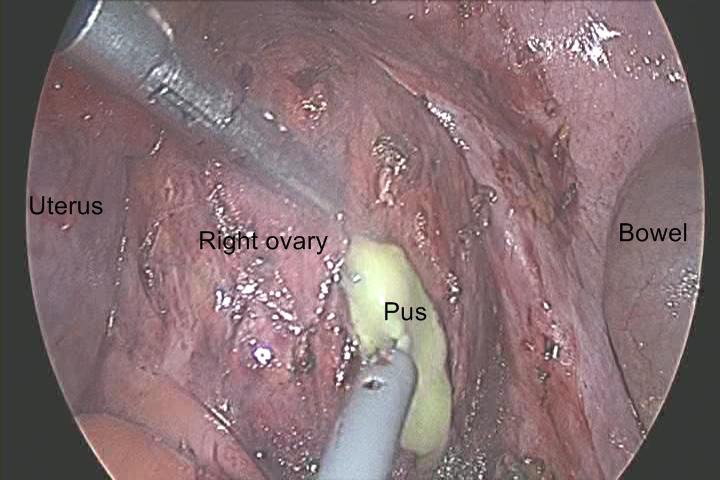 There was a 10 cm-sized right ovarian cyst including pus, which made severe adhesion with surrounding pelvic organs and peritoneum. It also had endometriotic lesion.