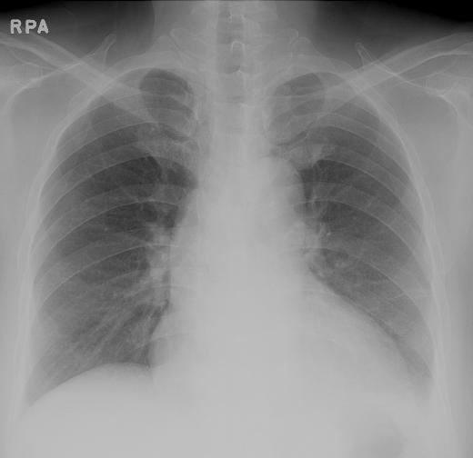 Tuberculosis and Respiratory Diseases Vol. 63. No.4, Oct. 2007 Figure 1. Chest X-ray on admission.