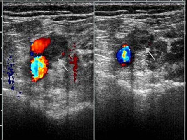 SY Kim et al: Pulmonary thromboembolism after post-menopause hormonal replacement therapy Figure 3. Lower Extrimity Doppler.