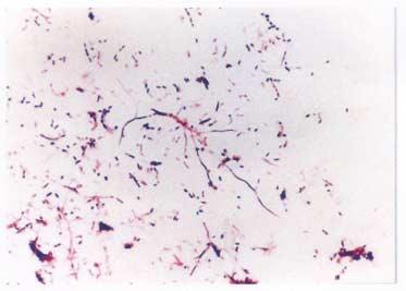 Nocardia asteroides type I 에의한폐렴 1 예 325 300 bp 200 bp 150 bp 100 bp 300 bp 200 bp 150 bp 100 bp 50 bp 75 bp A B Fig. 1. Gram stained smear showed long, branched, beaded Grampositive rods ( 1,000).