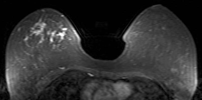 Fig. 1. 47-year-old women with ductal carcinoma in situ with microinvasion. A.