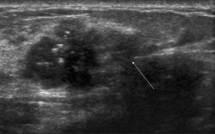 calcifications (arrow) at right breast. B.