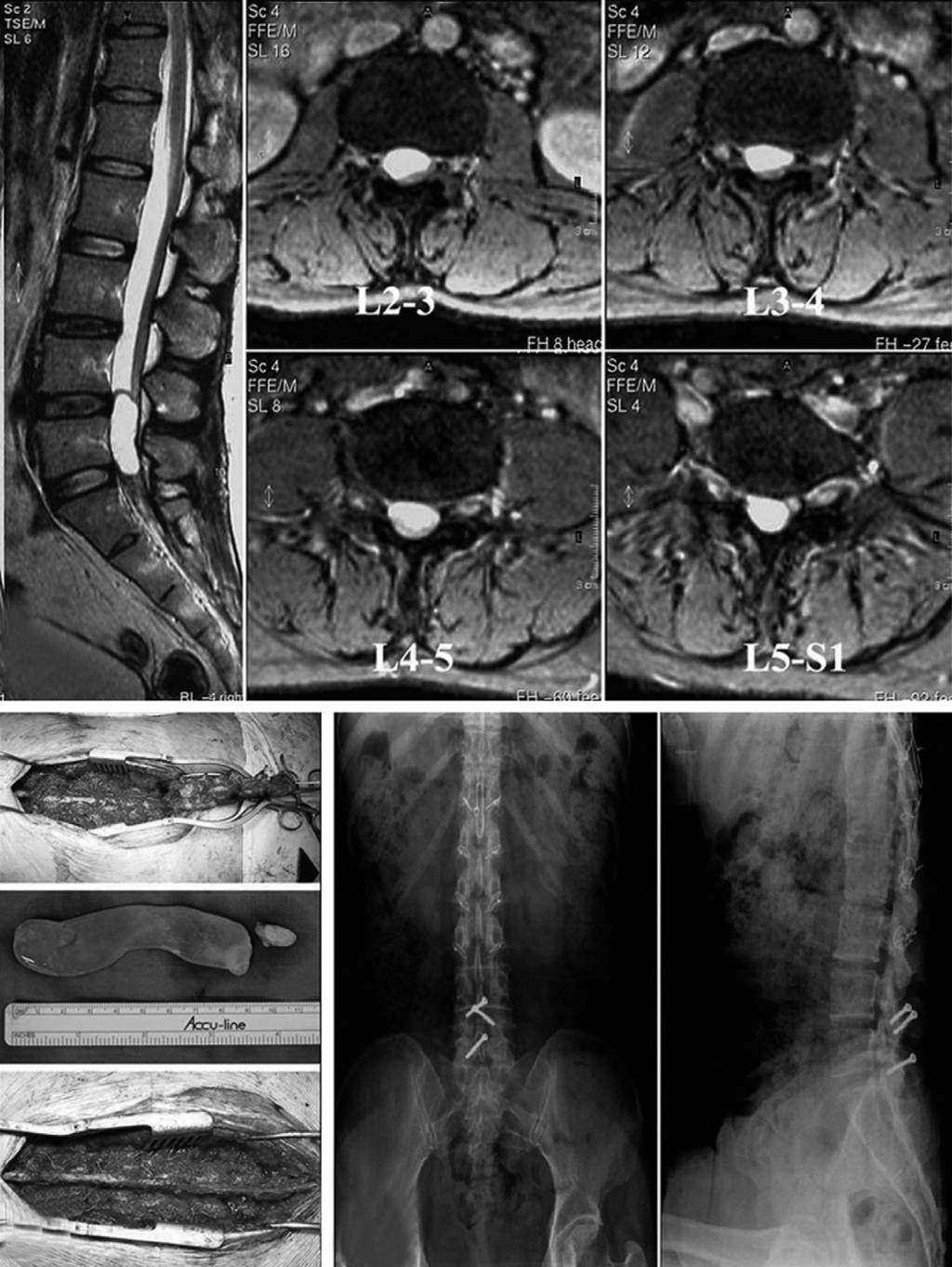 Recapping 추궁판성형술 -5 례보고 - 박원욱외 Fig. 1. (A) Preoperative MRI and plain X-ray shows type III arachoid cyst from L2 to L5 in the 43-year-old female patient. (B) Intraoperative photograph.