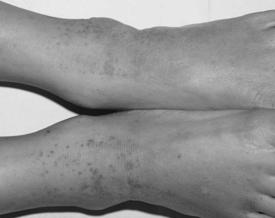 - 대한내과학회지 : 제 72 권부록 2 호 2007 - A Figure 1. Lesions of Skin : Purpura is shown on both the feet and trunk. 현병력 : 내원 1개월전만성부비동염및비강내용종으로이비인후과에서수술후투약중이었으며내원 1 주일전부터점점악화되는미만성복통과관절통으로응급실에내원하였다.