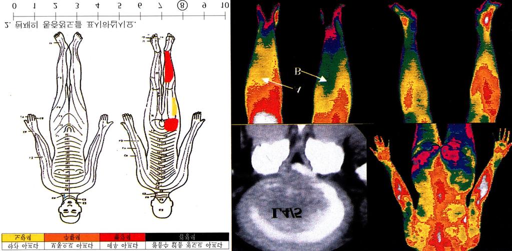 요추간반 탈출증에서 적외선 체열 촬영과 통증 척도와의 상관 관계 검사상 탈출의 정도가 심하지 않아도 통증이 심한 환자를 하는 데에 많은 도움을 주고 있다3). 자주 관찰하게 된다.