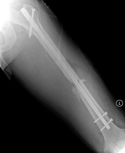(D) Antero-posterior radiograph of the hip after the secondary operation shows multiple screw fixation.