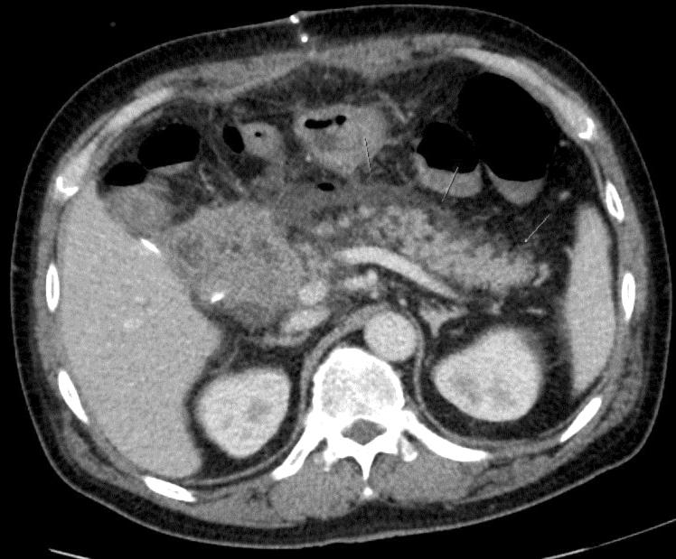 In Woong Han: Nutrition after Pancreatectomy Complications 25 아직그근거가충분하지않다.[20] 영양공급방법으로는정맥영양보다는경장영양이선호되며, 이는경장영양에서감염및재원기간, 수술적치료의필요성, 다기관부전, 사망률등의대부분의지표에서정맥영양에비해우월한것으로보고되기때문이다.